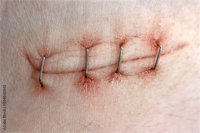 ESL vocab - a surgical staple