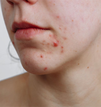 ESL Vocab - pimples